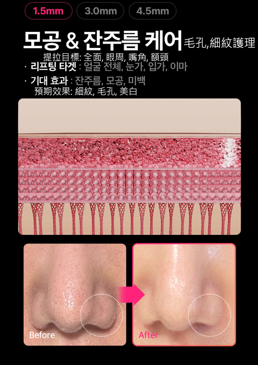 THERMATHERA 韓國無限發數 HIFU 美容儀 (1發10點)!!
