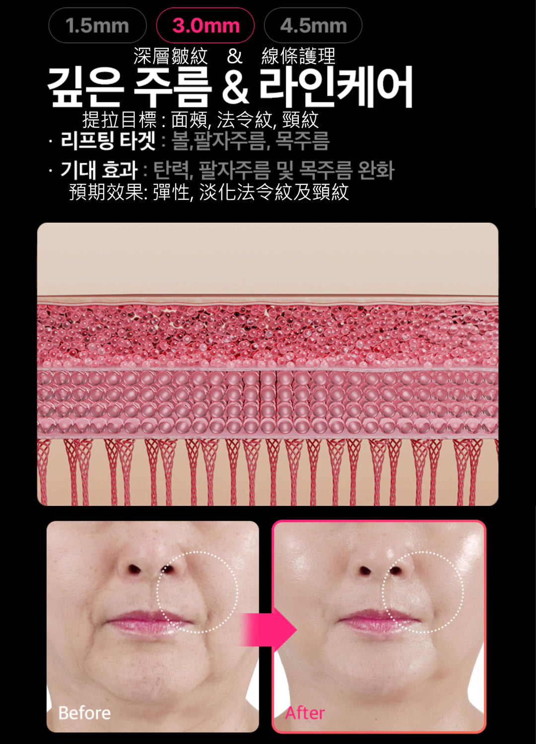 THERMATHERA 韓國無限發數 HIFU 美容儀 (1發10點)!!