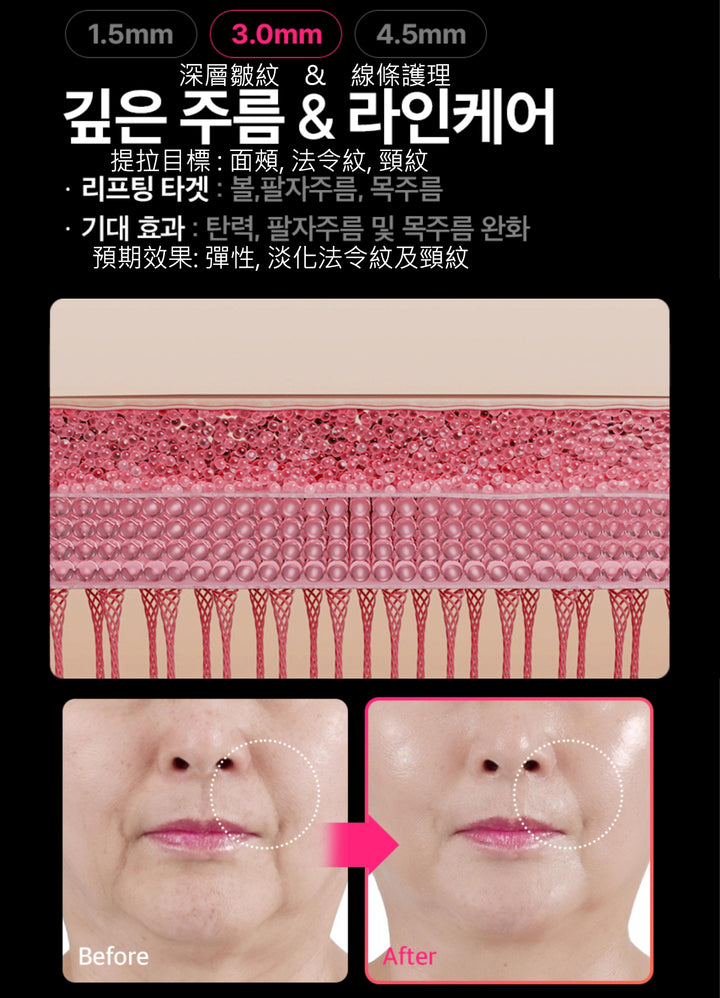 THERMATHERA 韓國無限發數 HIFU 美容儀 (1發10點)!!